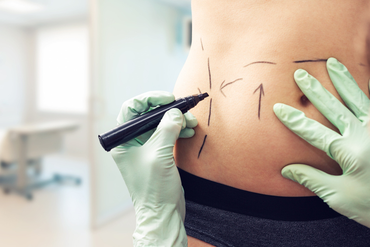 Qué debes saber antes de una liposución