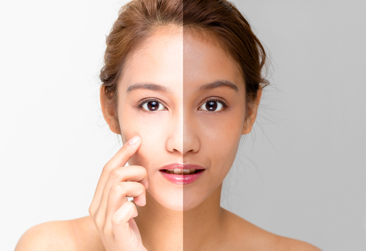 Corrección de la asimetría facial: Retrognatia Mandibular